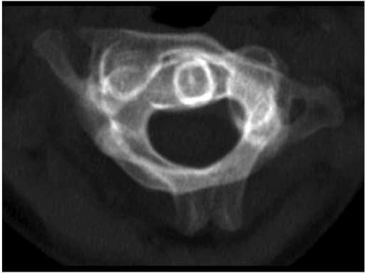 Axial CT through C1-C2 showing rotatory displacement of the atlas relative to the dens