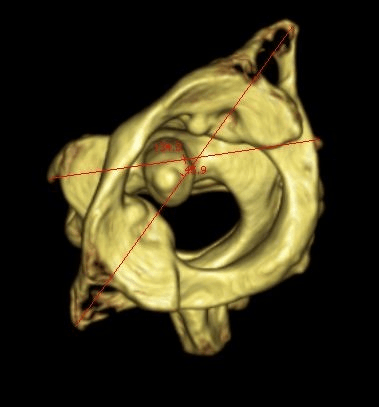 Three-dimensional CT reconstruction showing measured angular offset between C1 and C2