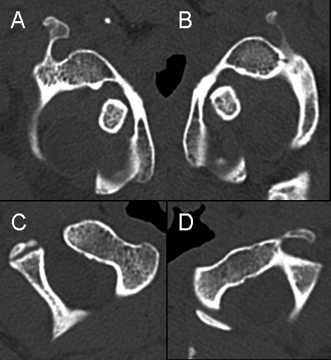 Four paired axial CT images comparing atlas and axis orientation during rotatory assessment