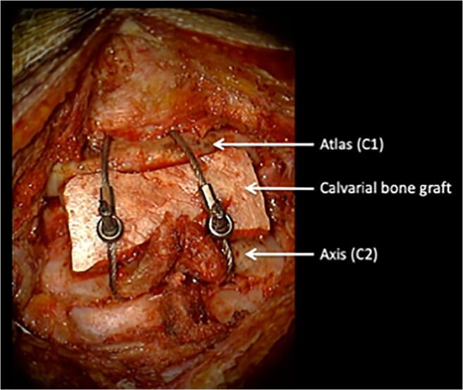 Posterior operative field showing modified Gallie C1-C2 fusion with calvarial graft and sublaminar cables