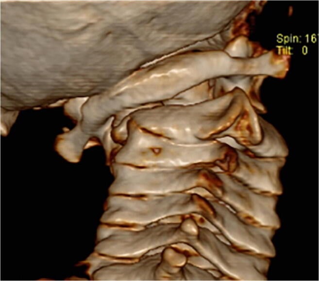 Posterior three-dimensional CT reconstruction showing fixed rotation of C1 relative to C2 in childhood atlantoaxial rotatory fixation