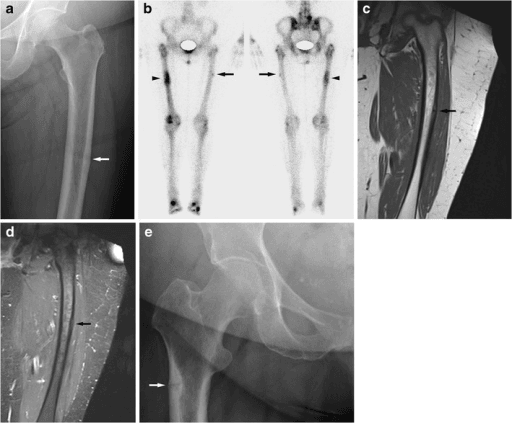 Multimodality imaging workup of atypical femoral fracture showing X-ray, bone scan, and MRI