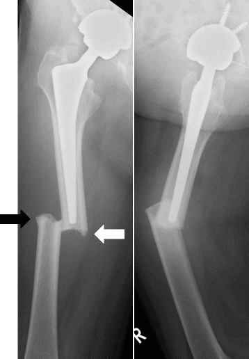 Atypical femoral fracture at femoral stem tip
