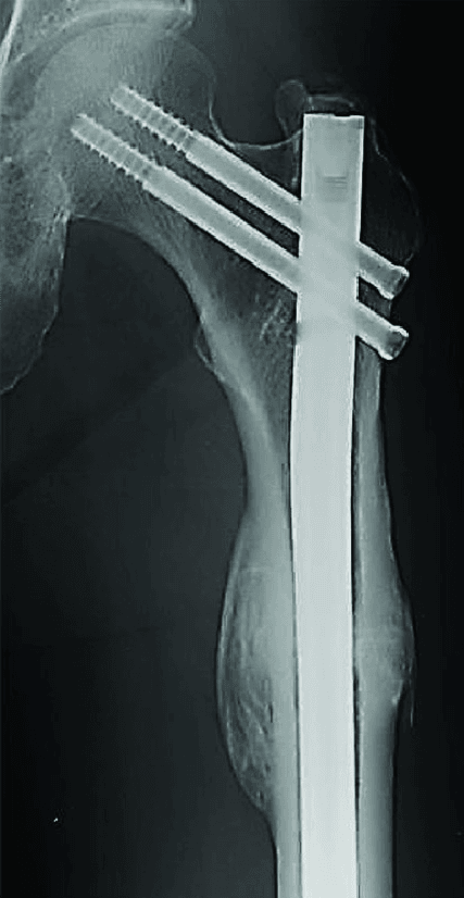 AP radiograph of the proximal femur after cephalomedullary nail fixation, with two screws into the femoral head and neck and callus at the subtrochanteric fracture