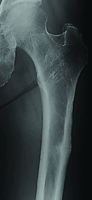 AP radiograph of the proximal femur showing focal thickening of the lateral cortex in the subtrochanteric region