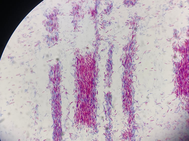 Ziehl-Neelsen microscopy showing clustered red acid-fast bacilli