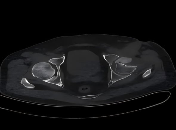 Axial CT at the level of the hip joints showing a flattened, fragmented left femoral head in Mycobacterium fortuitum infection