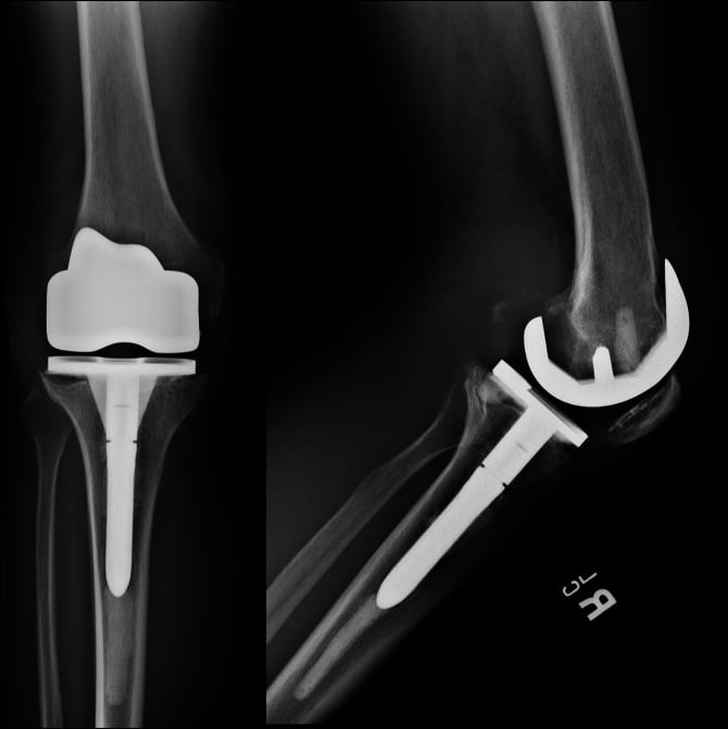 AP and lateral knee radiographs showing extensive osteolysis around an arthroplasty