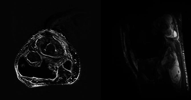 Axial and sagittal metal-suppression MRI showing fluid collections around a knee arthroplasty