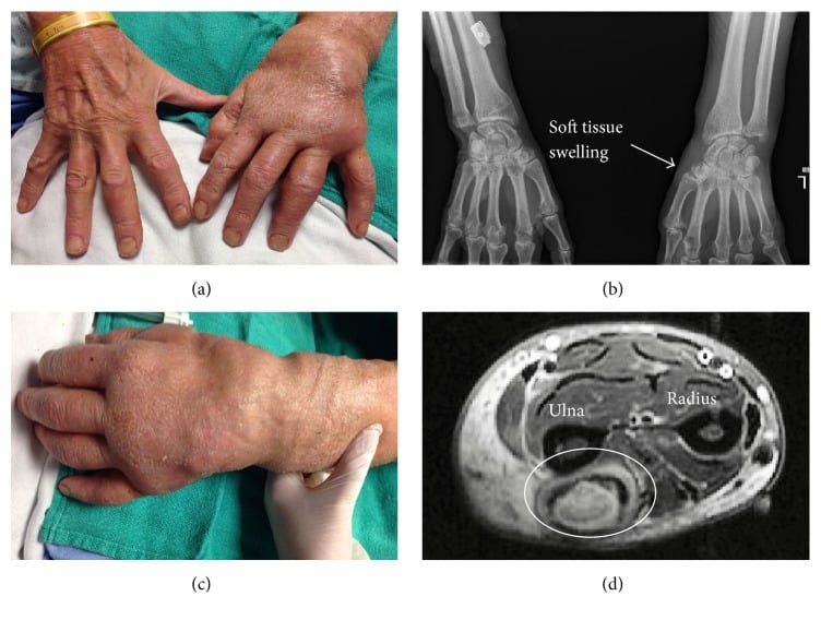Four-panel composite of disseminated Mycobacterium marinum infection: a swollen hand, hand radiographs labelled soft tissue swelling, and axial MRI with the ulna and radius labelled and a circled deep lesion