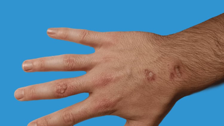 Healing crusted lesions on the dorsum of the hand after treatment for Mycobacterium marinum