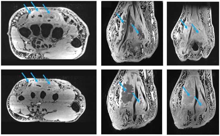 Axial and sagittal MRI showing massive extensor tenosynovitis from Mycobacterium marinum