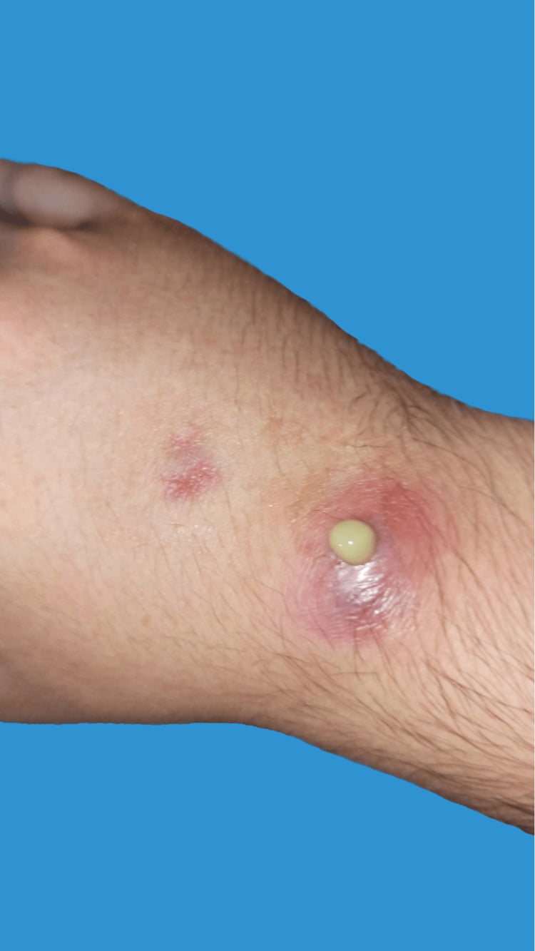 Two inflammatory nodules at the wrist caused by Mycobacterium marinum, one with a bead of yellow fluid on its surface