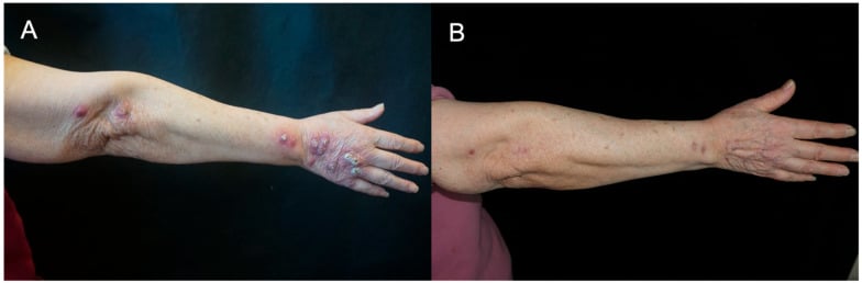 Before-and-after photographs of lymphocutaneous Mycobacterium marinum infection of the hand and forearm