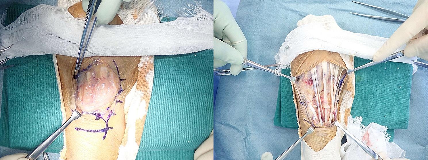 Operative views before and after extensor tenosynovectomy
