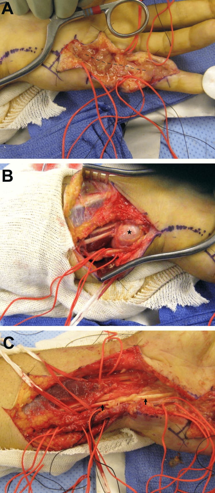 Three operative views of flexor tenosynovectomy, from the digit and palm to the distal forearm, with red vessel loops