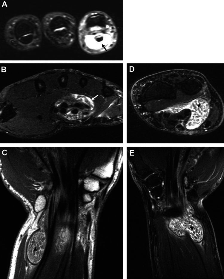 Five-panel MRI of flexor tenosynovitis: fluid in a digital flexor sheath, thickened synovium, and a sheath packed with innumerable small low-signal rice bodies