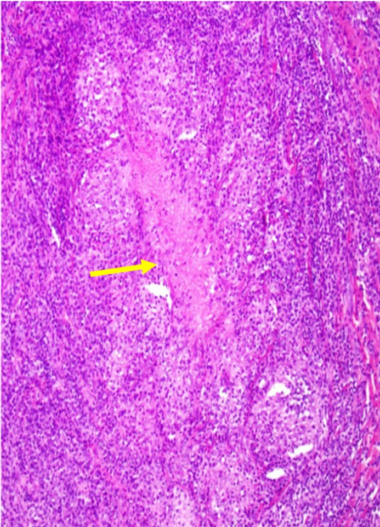 Histology showing an epithelioid granuloma with central necrosis marked by a yellow arrow
