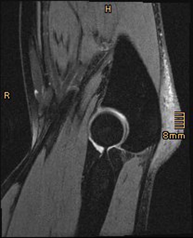Sagittal elbow MRI showing thickened olecranon bursa