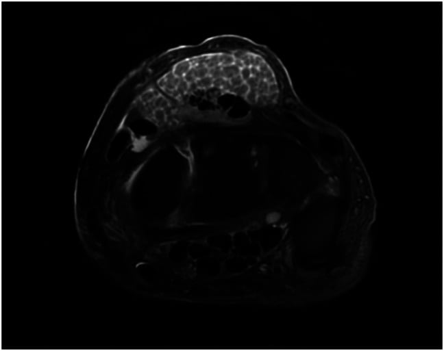 Axial wrist MRI showing rice bodies and partial extensor tendon rupture