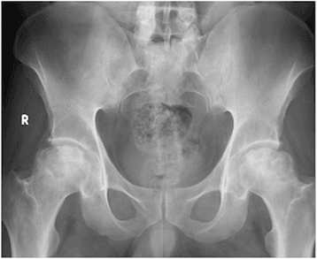 Bilateral avascular necrosis of femoral heads on AP pelvis radiograph