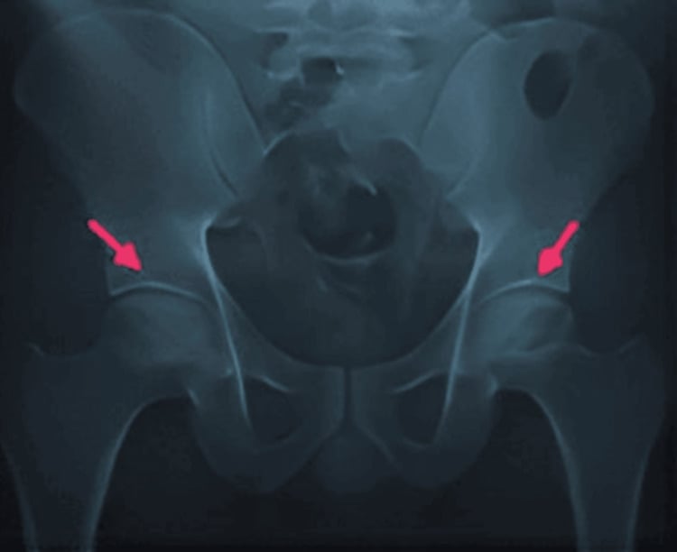 Bilateral Ficat Stage III AVN on AP pelvis radiograph