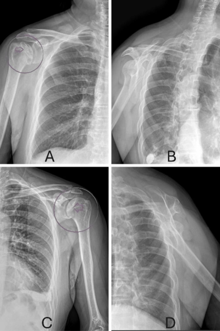 AP shoulder radiographs demonstrating bilateral humeral head avascular necrosis with subchondral sclerosis