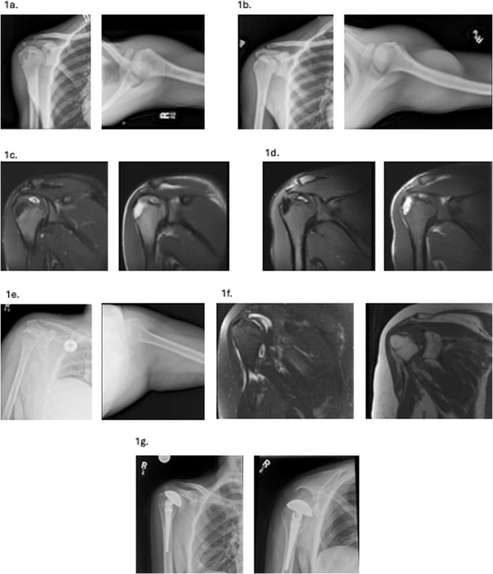 AP shoulder radiographs and coronal T1/T2 MRI demonstrating humeral head avascular necrosis and subchondral crescent sign