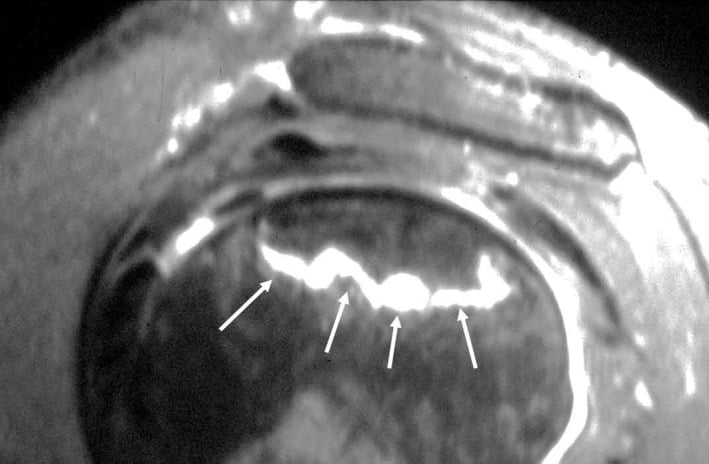 Shoulder MRI with arrows marking a high-signal reactive interface around osteonecrosis