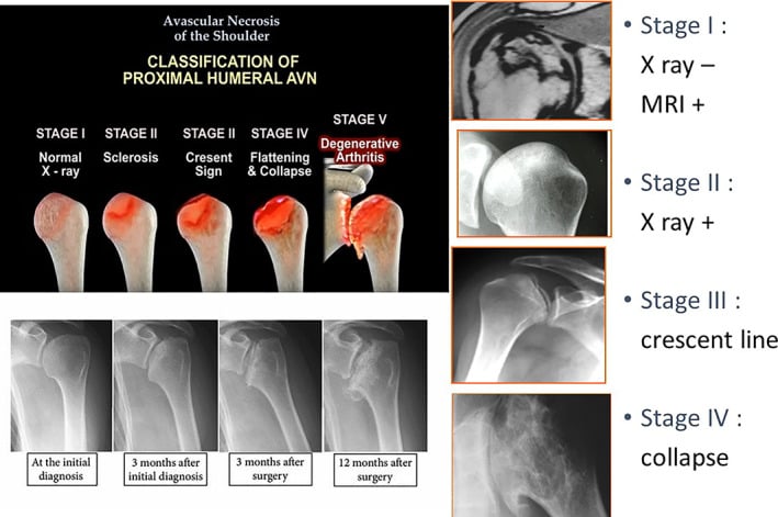 Illustrated Cruess stages I to V of shoulder osteonecrosis with example radiographs and MRI