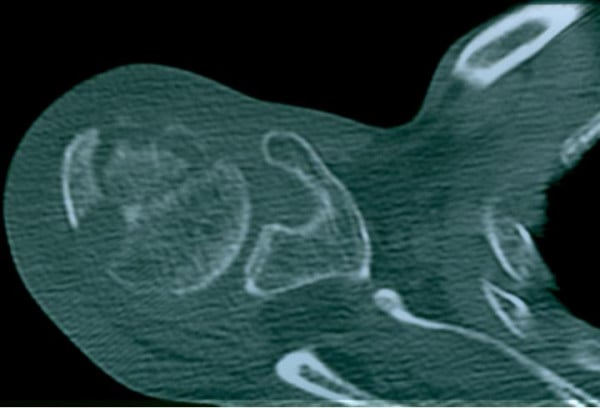 CT of the shoulder showing a humeral head with a mottled internal pattern and curvilinear subchondral lines