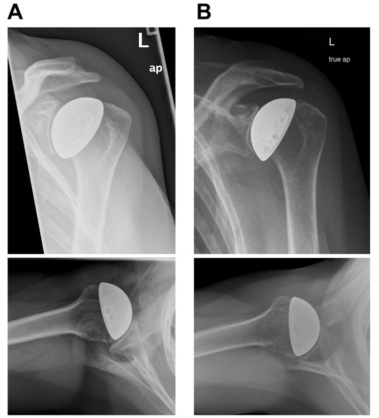 Baseline and 17-year shoulder radiographs after cementless humeral-head resurfacing for osteonecrosis