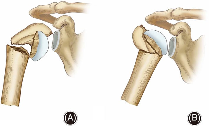 Illustration comparing disrupted and preserved medial hinges in proximal humerus fractures