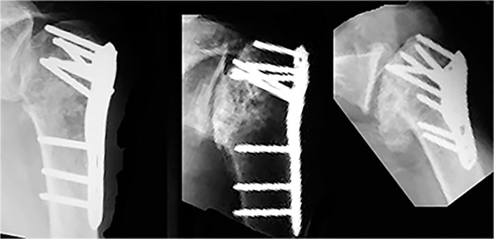Serial shoulder radiographs showing a proximal humerus fracture progressing to humeral-head osteonecrosis
