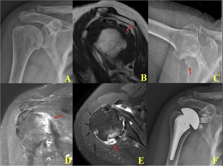 Radiographs and MRI of rapidly progressive destructive arthropathy of the shoulder, ending in a reverse shoulder arthroplasty