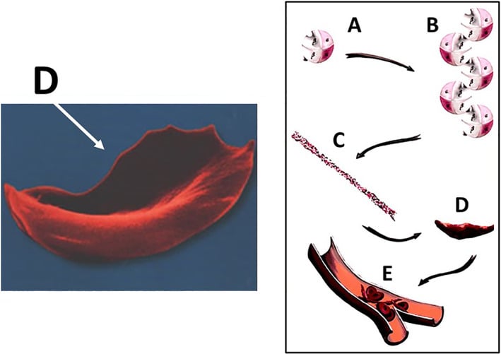 Schematic of haemoglobin S polymerisation, red-cell sickling and small-vessel occlusion