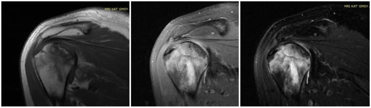 Three MRI images of a humeral head with osteonecrosis