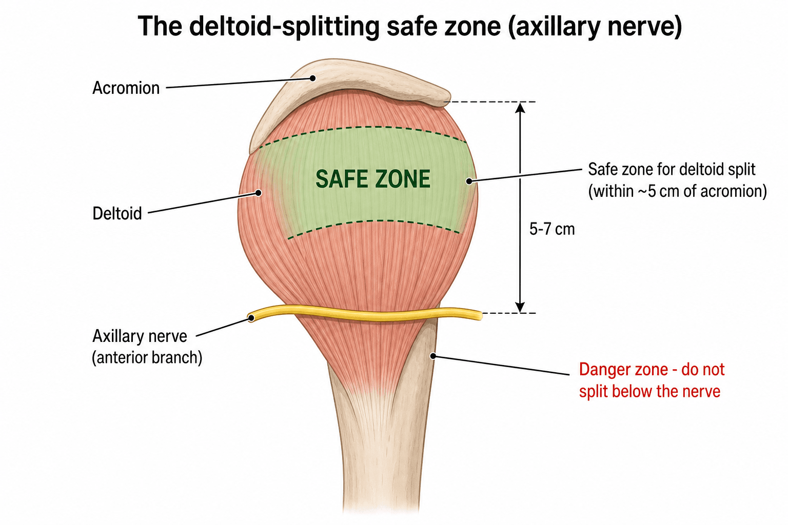 Lateral-shoulder diagram of the deltoid-splitting safe zone: the axillary nerve runs transversely around the humerus about 5 to 7 cm below the acromion, with a green safe zone above it and a danger zone at and below the nerve