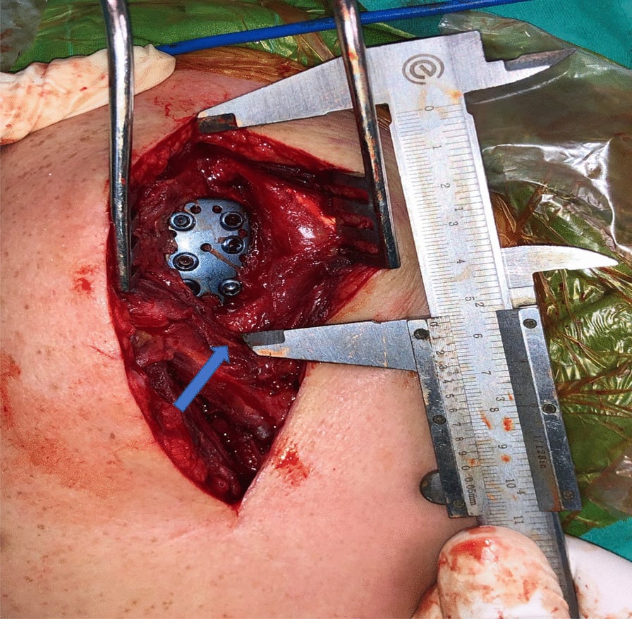 Intraoperative caliper measurement from the anterolateral acromion to the axillary nerve during a deltoid-splitting approach.