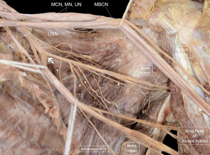 Anterior cadaveric dissection of the posterior cord, axillary nerve and its branches to subscapularis and teres minor.
