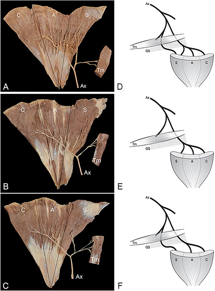 Three cadaveric axillary nerve branching patterns to the clavicular, acromial and spinous deltoid and teres minor with matching schematics.