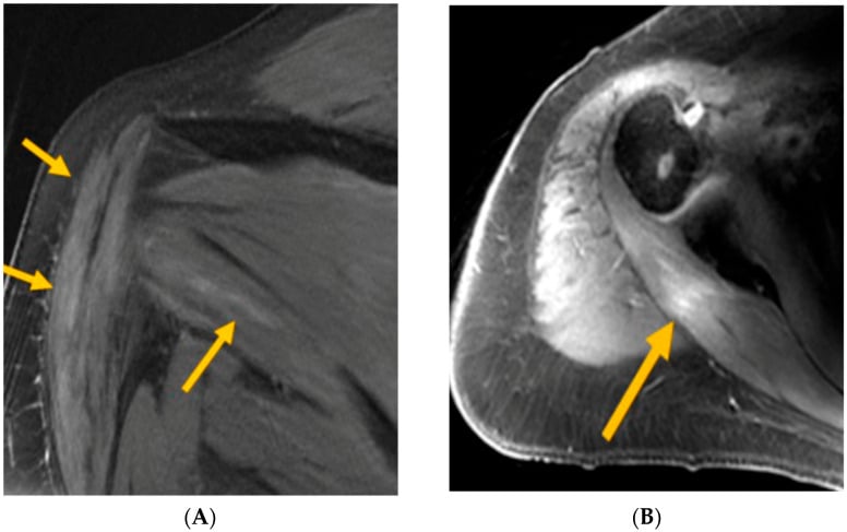 Shoulder MRI showing T2 fat-suppressed oedema in the deltoid and teres minor in axillary neuropathy.