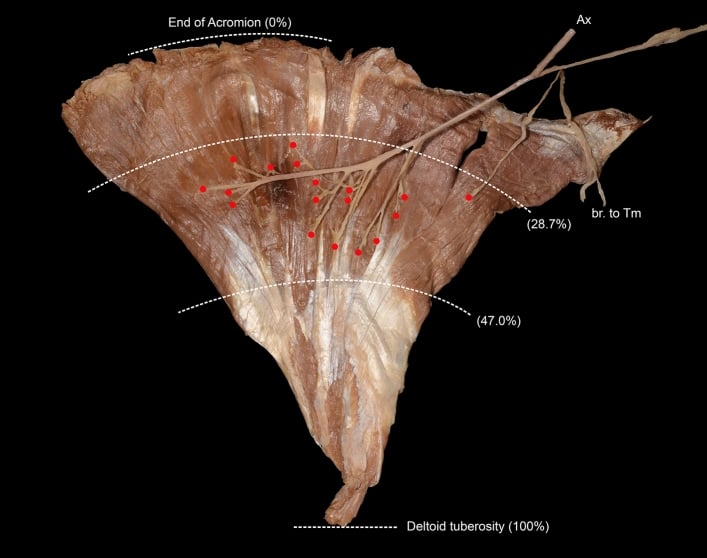 Cadaveric deltoid viewed from its deep surface with axillary nerve entry points mapped between the upper quarter and midpoint.