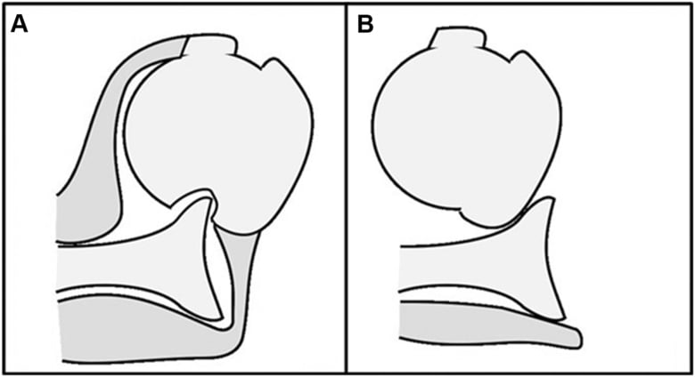 Paired schematic of typical anterior shoulder dislocation and excessive displacement with rotator cuff tear causing greater axillary nerve traction.