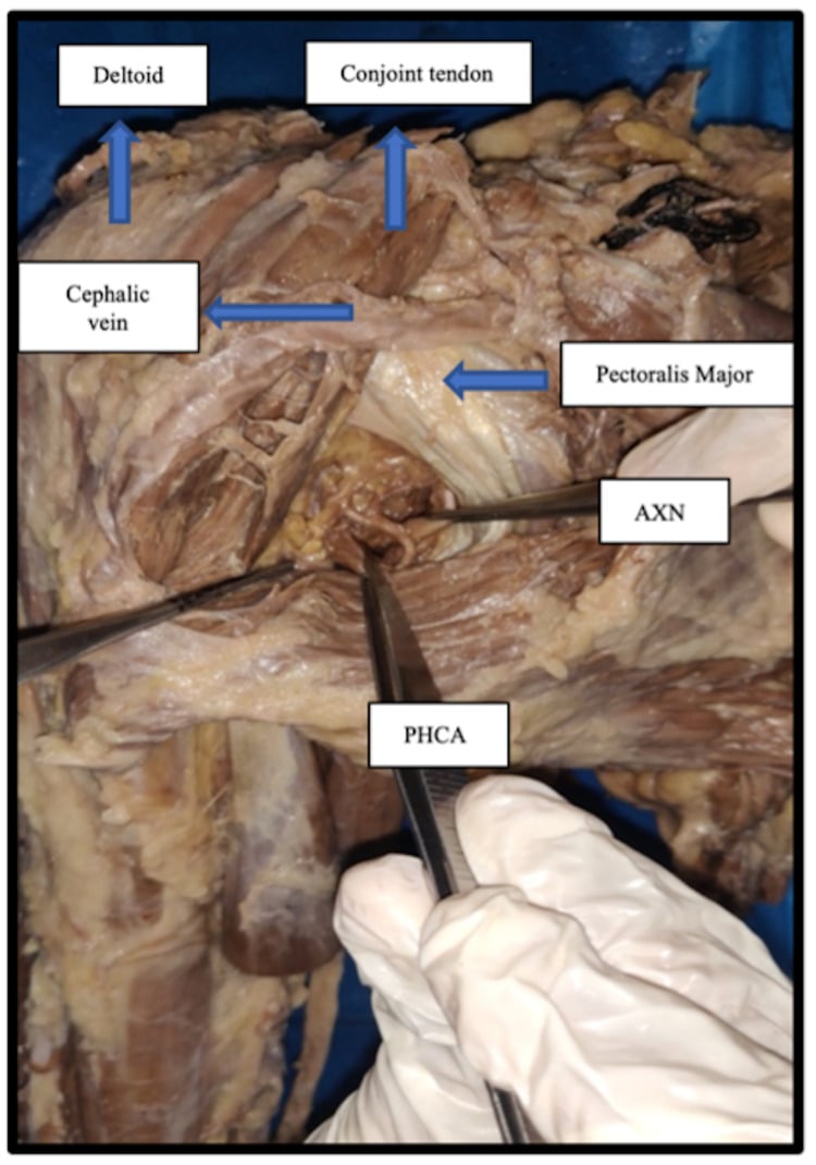 Anterior cadaveric deltopectoral approach exposing the axillary nerve and posterior circumflex humeral artery at the quadrilateral space.