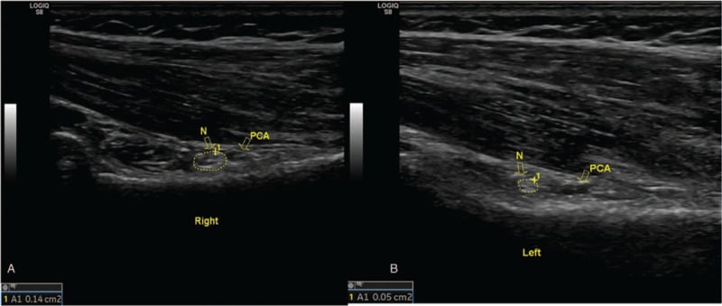 Bilateral quadrilateral-space ultrasound comparing an enlarged right axillary nerve and flattened PCHA with the normal left side.