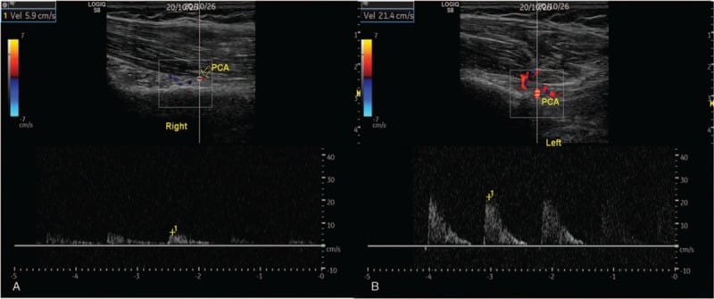 Bilateral Doppler ultrasound waveforms showing reduced posterior circumflex humeral artery flow on the symptomatic side in QSS.