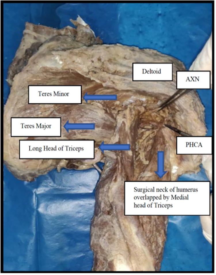 Posterior cadaveric approach showing teres minor, teres major, long head of triceps, axillary nerve and PCHA at the quadrilateral space.