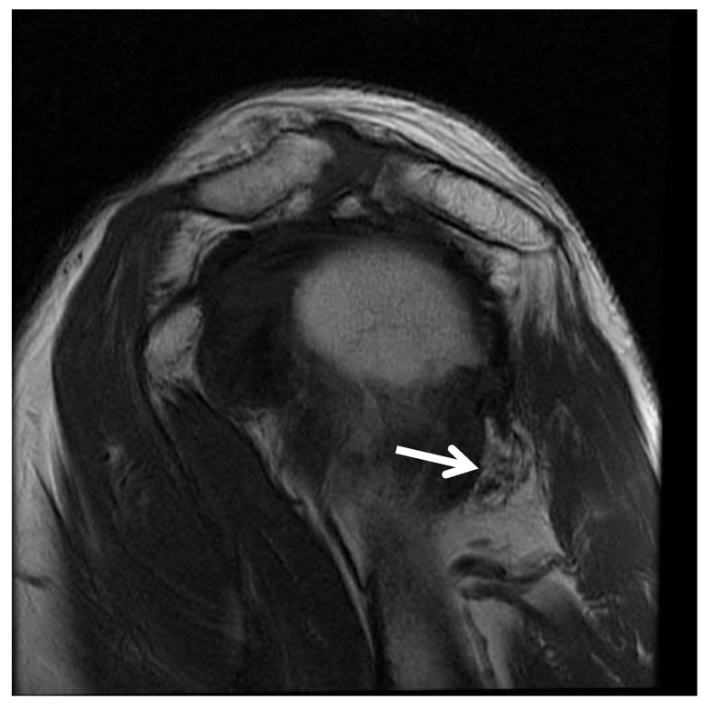 Axial shoulder MRI showing isolated teres minor atrophy in quadrilateral space syndrome.