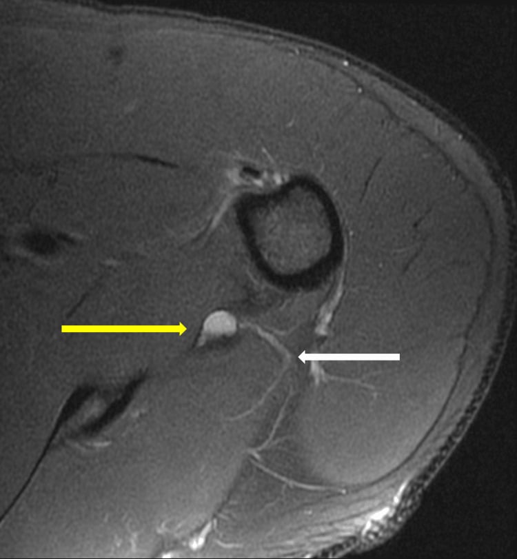 Axial T2 shoulder MRI showing an inferior paralabral cyst abutting the axillary nerve in the quadrilateral space.